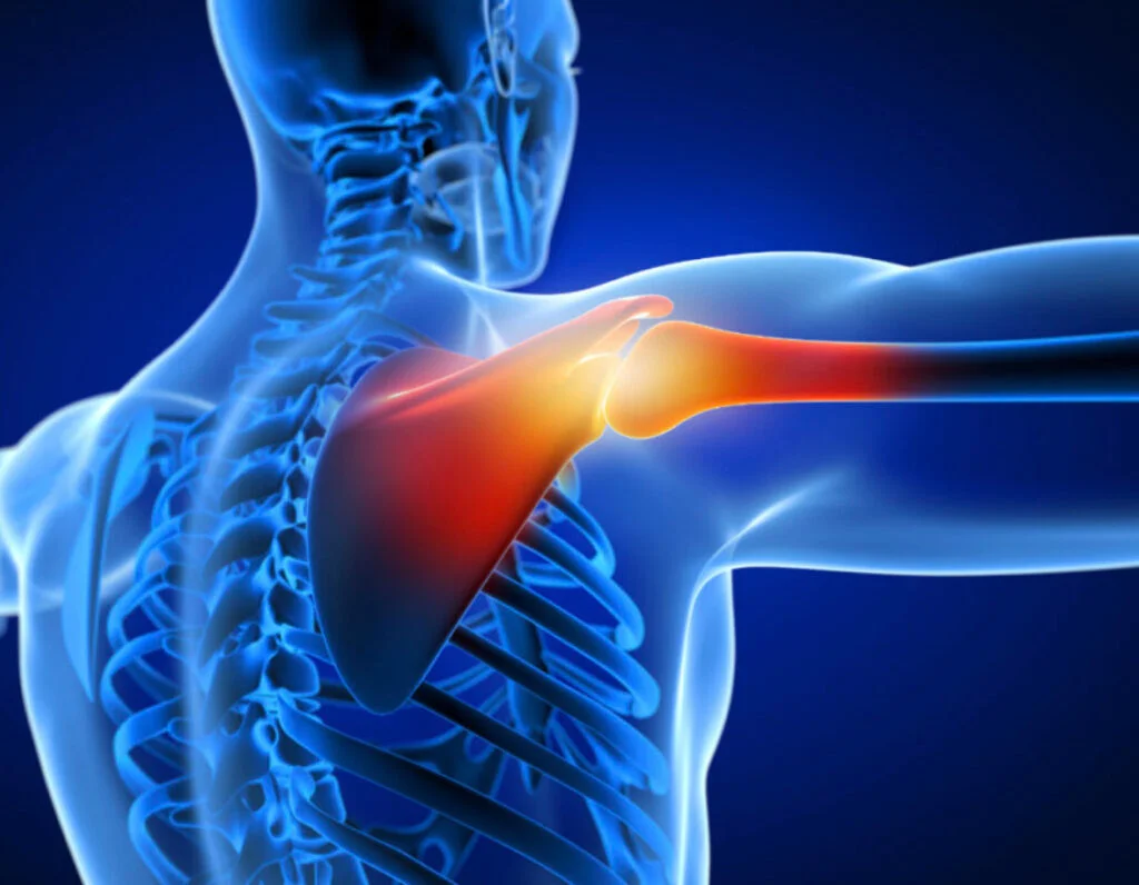 Grafika obrazująca bolący bark