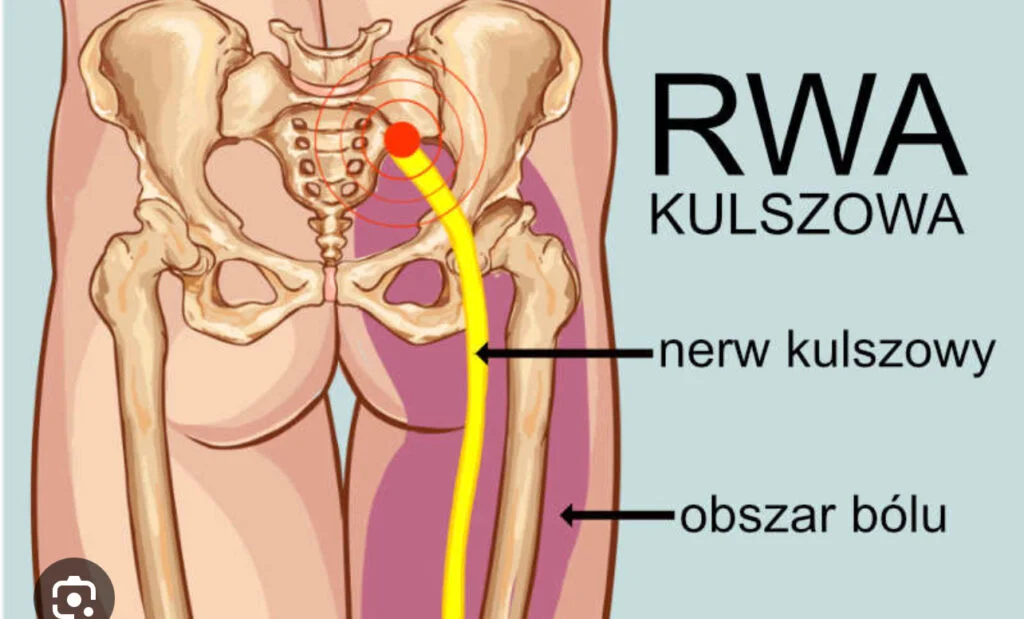rwa kulszowa rysunek